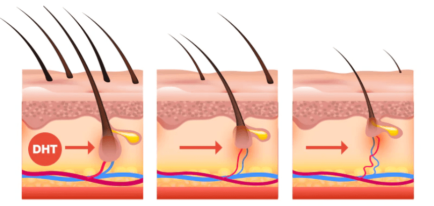 DHT có thể sẽ ảnh hưởng xấu đến các giai đoạn trong quá trình mọc tóc