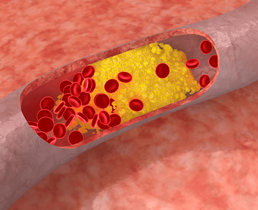 LDL cholesterol tích tụ trên thành động mạch gây nguy cơ xơ vữa động mạch