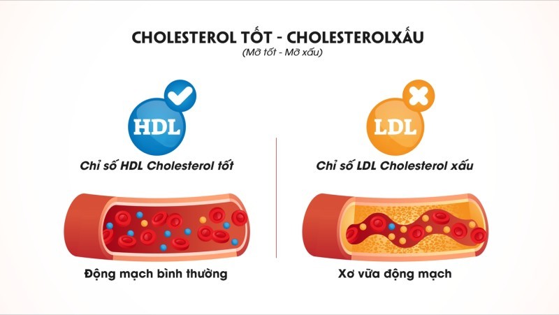 Cholesterol xấu là gì? Vì sao lại nguy hiểm?