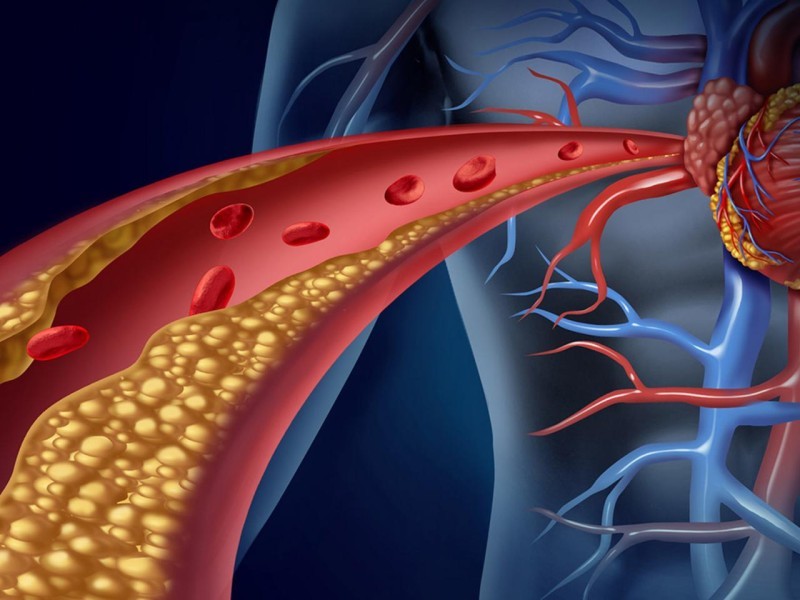 Nguyên nhân phổ biến gây tăng cholesterol máu