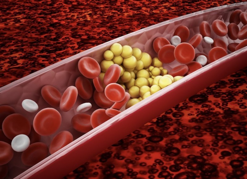 Tăng cholesterol máu