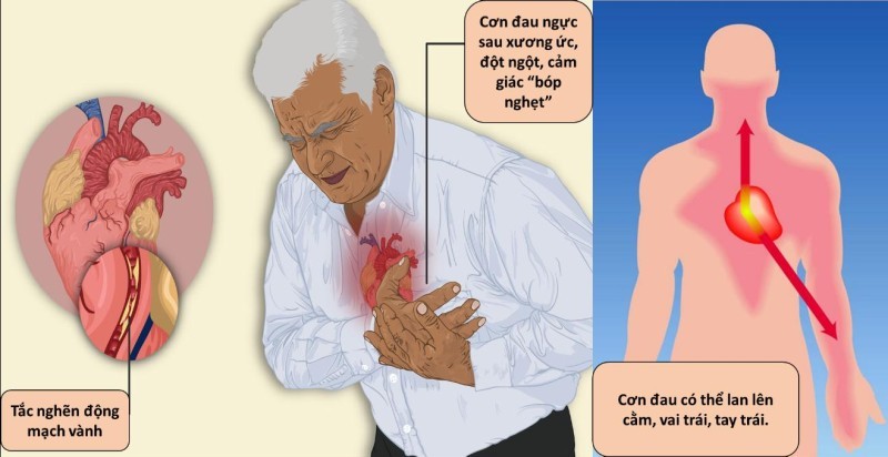 Nhận biết sớm dấu hiệu nhồi máu cơ tim để giảm biến chứng
