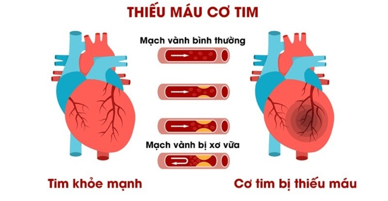 Thiếu máu cơ tim là gì và nguyên nhân do đâu?