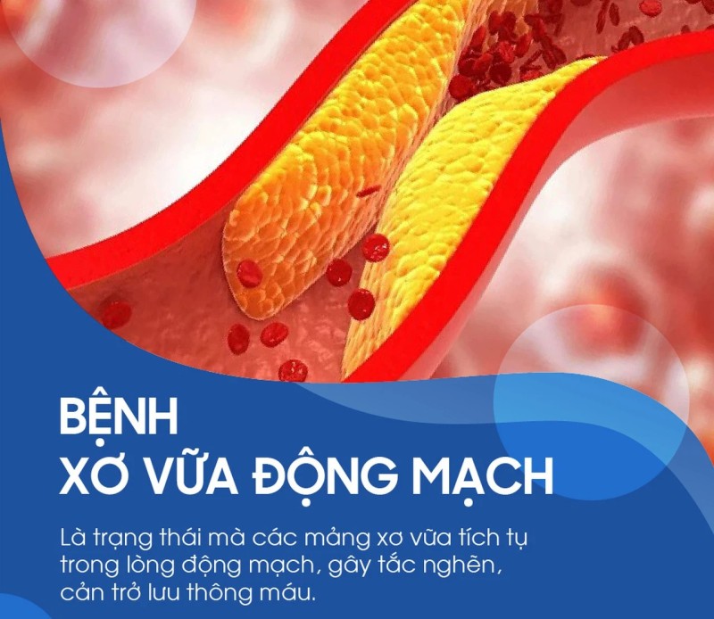 Bệnh Xơ Vữa Động Mạch Là Gì?