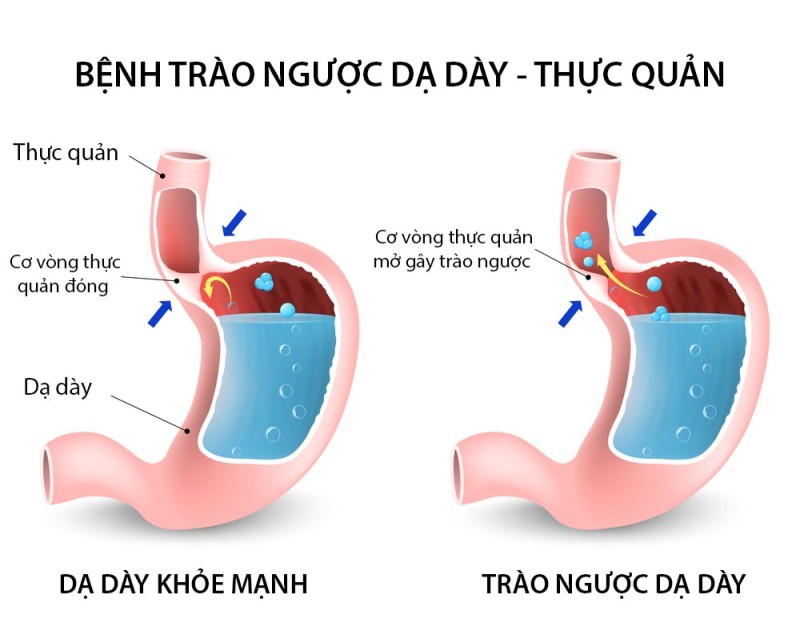 Trào ngược dạ dày: Sự phổ biến và hệ lụy bạn không nên bỏ qua?