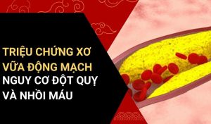 triệu chứng xơ vữa động mạch