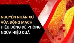 nguyên nhân xơ vữa động mạch