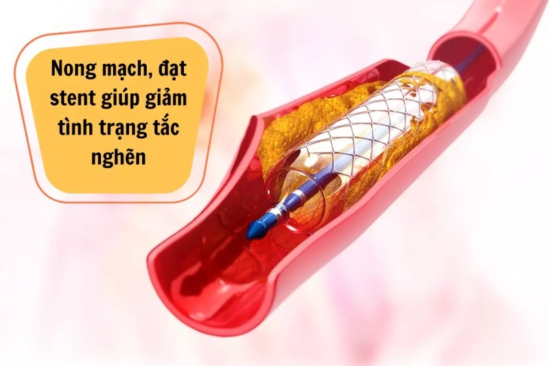 Cách Phát Hiện Và Kiểm Soát Bệnh Xơ Vữa Động Mạch Từ Sớm