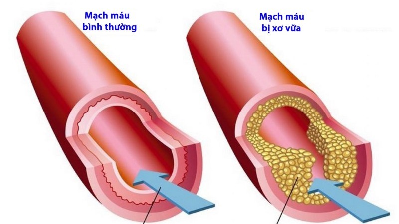 Xơ Vữa Động Mạch Là Gì?